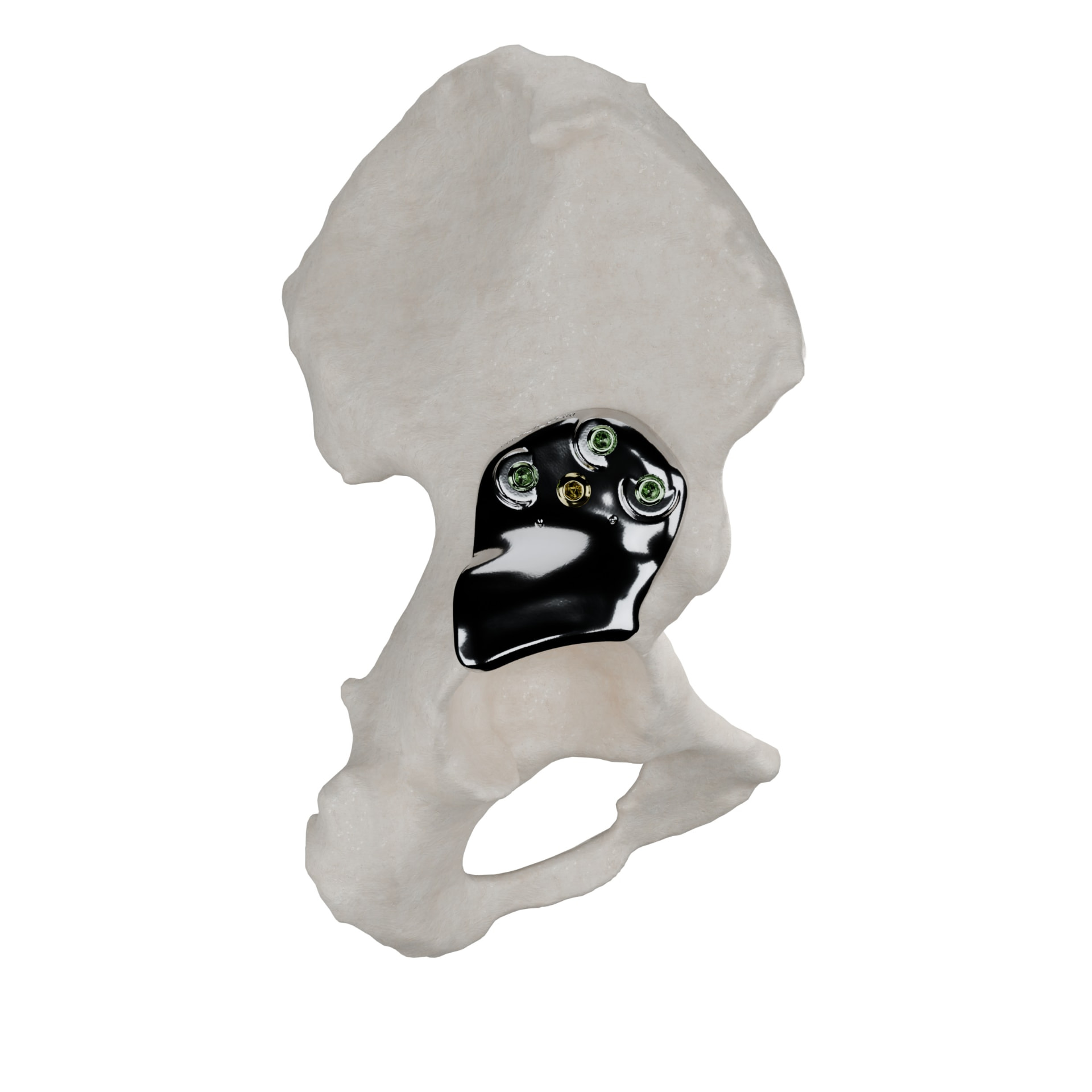Patient-specific 3D-Shelf implant fitted to a pelvic bone model, secured with screws