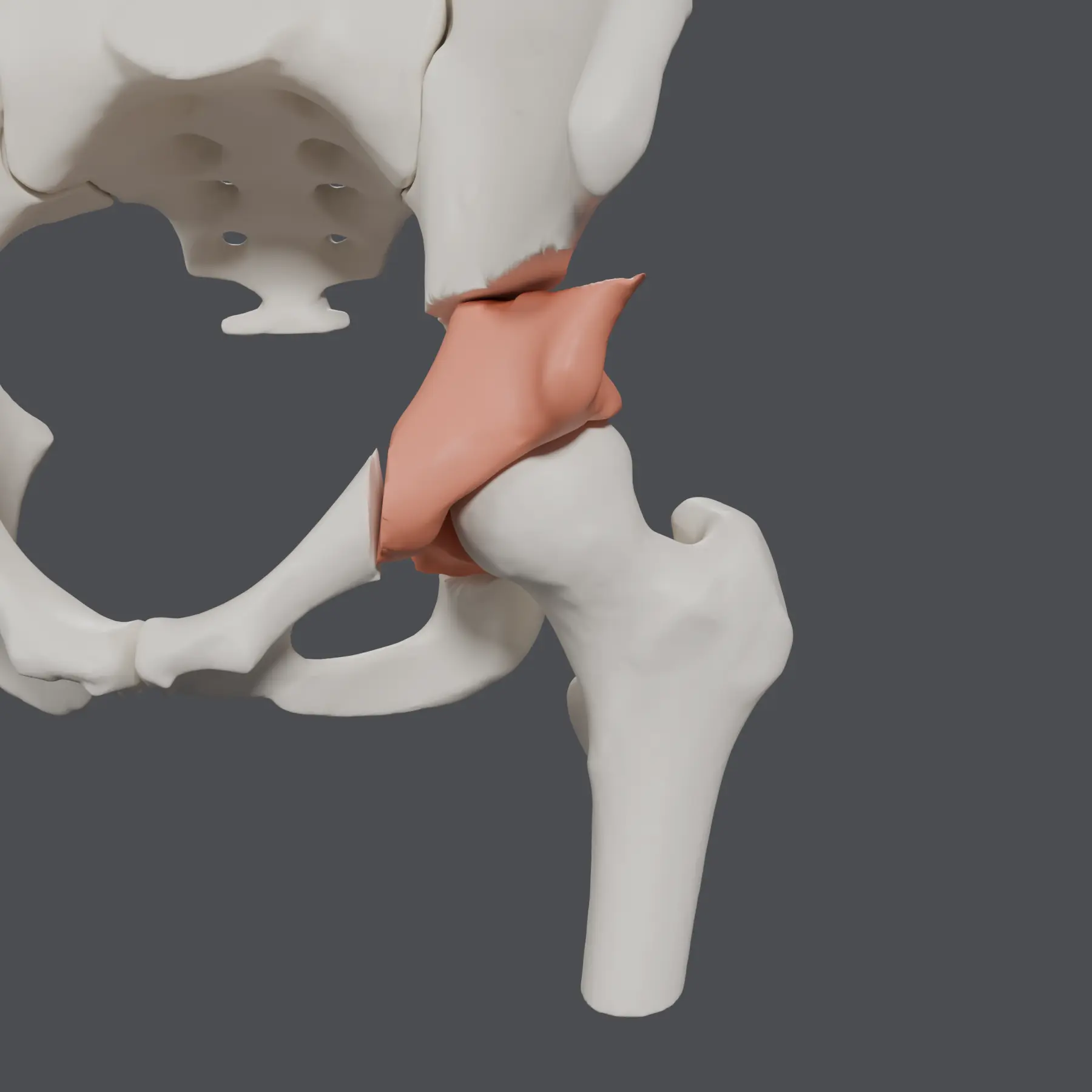 3D pelvic reconstruction illustrating a candidate acetabular reorientation with a displaced acetabular fragment