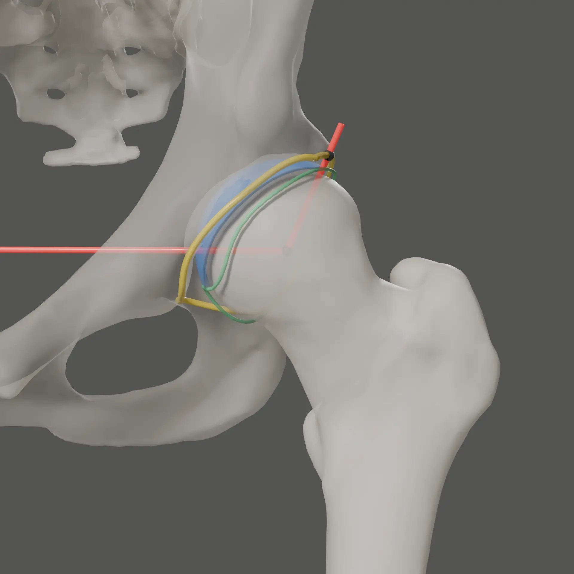 3D hip reconstruction with a lateral center-edge angle measurement overlaid on the femoral head and acetabulum