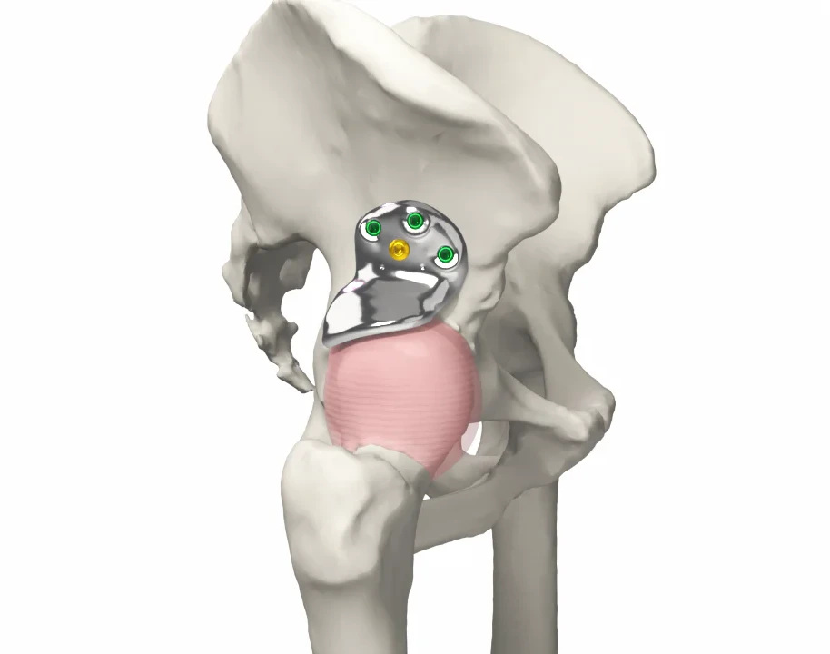Patient-specific 3D-Shelf implant fitted to a pelvic bone model, secured with screws