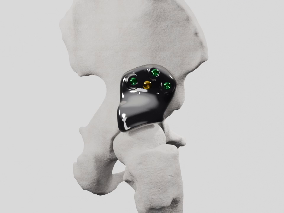 Patient-specific 3D-Shelf implant fitted to a pelvic bone model, secured with screws